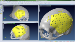 The head scan and prosthesis model design using VISI CAD