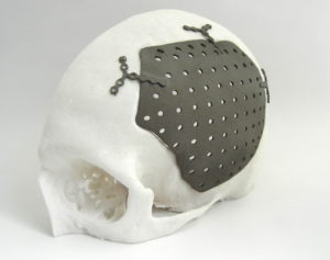 The 3D prototype model of the skull cavity and prosthetic implant